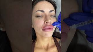 Lips Filler Treatment by our Cathy  Ageless MD [upl. by Ardek]