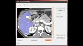 Liver extraction and 3D visualization [upl. by Anawak156]