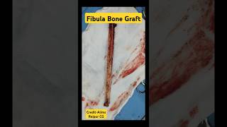 Fibula Bone Graft 🔥 फ़िबुला ग्राफ्ट fibula fibulafracture grafting bonefracture [upl. by Nennahs580]