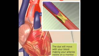 Angiogram [upl. by Ralat]