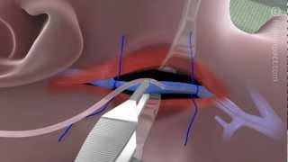 Proper Technique for Internal Jugular Cannulation [upl. by Gothar]