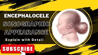 Encephalocele explain the sonographic appearance and How it shows on ultrasound [upl. by Reaht]