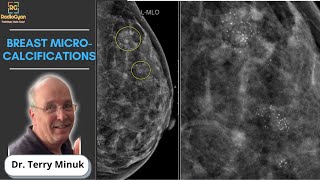 Mastering Mammography Understanding Breast Microcalcifications  Dr Terry Minuk [upl. by Hillery]