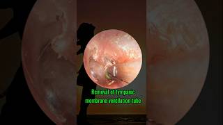 Removal of tympanic membrane ventilation tube treatment of otitis media [upl. by Inah]