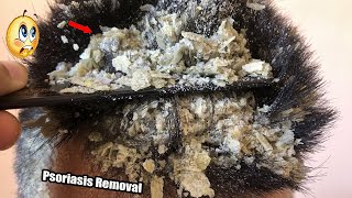 Huge flakes dandruff removal off big flakes  ASMR Scratching 803 [upl. by Aicsila]