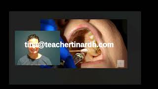 TIPS FOR PALATAL INJECTIONS [upl. by Egidio]