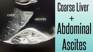 Coarse Liver amp Abdominal Ascites on Ultrasound  Chronic Liver Disease  Liver Cirrhosis [upl. by Ailecara]