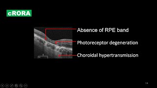 New Lexicon in Dry AMD Part 1 cRORA [upl. by Wehrle]