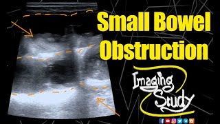 Small Bowel Obstruction  Ultrasound  Case 153 [upl. by Nich]