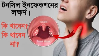 টনসিল ইনফেকশনের লক্ষণ  Tonsils infection symptoms  tonsil treatment at home in bengali [upl. by Atoiganap]