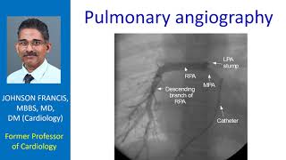 Pulmonary angiography [upl. by Aillemac]