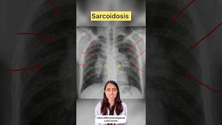 Sarcoidosis xray xrayclasses chest lungs pulmonologist sarcoidosis pulmonary radiology [upl. by Anhej816]