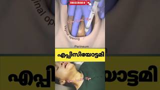 പ്രസവസമയത്ത് episiotomy ചെയ്യുന്നത്pregnancy education malayalam [upl. by Leirraj]