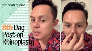 Rhinoplasty In the Philippines 8th Day Post Opp [upl. by Nonac]