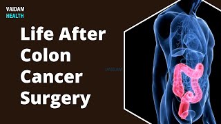 Life After Colon Cancer Surgery [upl. by Prudi]