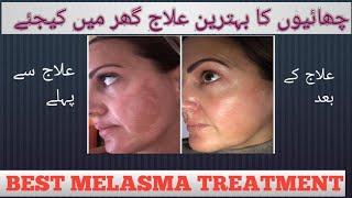 Treat Melasma At Home  Best Melasma Treatment  Dr shahzad Hashmi Lecture 107 [upl. by Lynd]