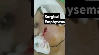 Surgical emphysema Surgitube doctor [upl. by Vi901]