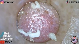 PORE VACUUM BLACKHEAD REMOVAL DEMO FOR Week32 CLASSICAL MUSIC brpvph​satisfying [upl. by Eniahs]