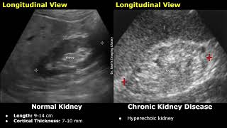 Kidney Ultrasound Normal Vs Chronic Kidney Disease CKD Imaging Findings  Chronic Renal Failure [upl. by Isidoro]