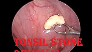 Tonsil Stone  Infected Cheesy Material Removal from Tonsillar Crypt [upl. by Sollie]