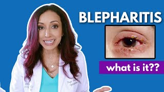 What Is Blepharitis Eye Doctor Explains [upl. by Gannon]