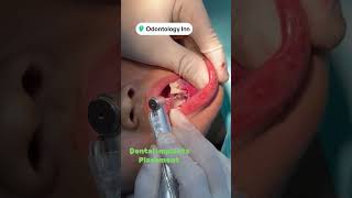 DENTAL IMPLANT INSERTION INTO BONE BY DENTAL IMPLANT SPECIALIST DR MUHAMMAD AHMAD [upl. by Leuname]