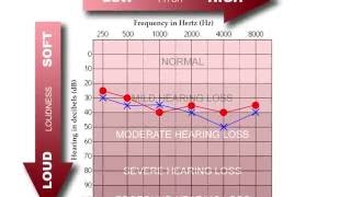 How to Read an Audiogram [upl. by Coriss]