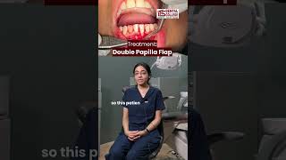 Case Of The Week  Root Coverage by Double Papilla Flap Procedure  ITS Dental Colege [upl. by Zachar488]