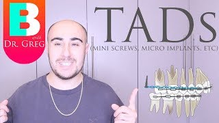 BRACES EXPLAINED TADs  Mini Implants [upl. by Jervis]