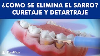 ¿Cómo se ELIMINA EL SARRO  Curetaje y limpieza dental © [upl. by Symons]