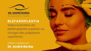 Blefaroplastia ou cirurgia das pálpebras superiores  Passo a passo por Dr André Borba [upl. by Kirtap591]