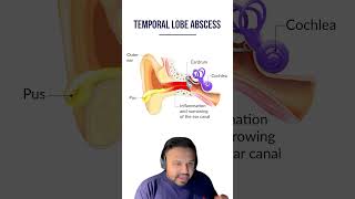 Mastoiditis for the USMLE  HyGuru [upl. by Jeremie]