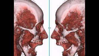 Articulación Temporo Mandibular ATM a través de TC 4D [upl. by Nilesoj]