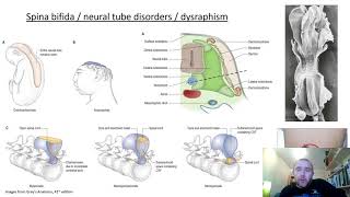 Neural tube defects [upl. by Coyle537]