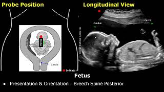 Obstetric Ultrasound Probe Positioning  Pregnant Uterus amp Fetus Transducer Placement USG Scan [upl. by Tomasina]