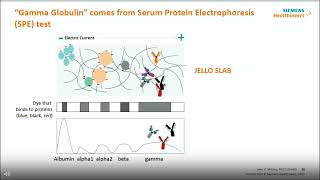 Evaluating Monoclonal Gammopathy of Undetermiend Significance MGUS with Free Light Chain Assays [upl. by Mcgaw]