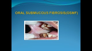 Oral Submucous FibrosispptOSMF [upl. by Norraa]