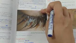 Blepharitis  anterior  posterior  EYELIDS LECTURE 3 JATOI [upl. by Gebelein148]