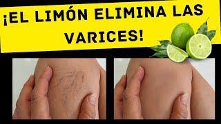 ¡El limón elimina las varices Solo haz esto todos los días [upl. by Ameen615]