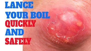 lancing a boil  How To Actually lance a boil  Pop cyst  Infectious skin warts [upl. by Aicrag]