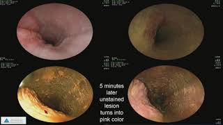 Early Detection of Esophageal Cancer and Barrett’s Esophagus Recent Advances [upl. by Aennaej]