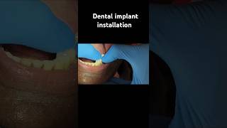 All on 4 implantdentist dentalclinic teeth tooth ytshorts insiderscraft [upl. by Arem]