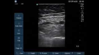 Saphenous Nerve block at adductor canal for Knee Arthroscopy [upl. by Vookles]