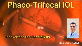 Phacoemulsification and Trifocal IOL Inadvertent Zonular Dialysis [upl. by Neyugn136]