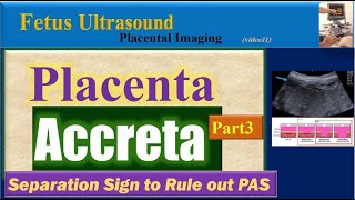 Fetus Ultrasound Placenta Accreta Part3 [upl. by Zohar]