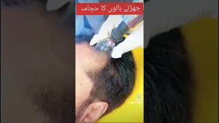 Hair fall hijama treatment by dr hafsa haider homeo physican [upl. by Garrity30]