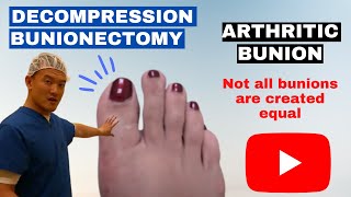 Decompression Bunionectomy Arthritic Bunion [upl. by Christa]