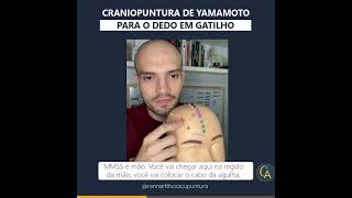 Craniopuntura para dedo em gatilho [upl. by Rennane398]