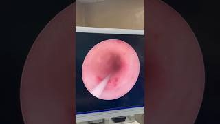 Ureterorenoscopy  right upper ureteric stricture ureter urologist endourology [upl. by Ehcram]