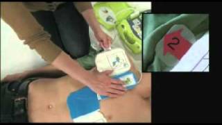 Applying Electrodes and Delivering a Shock with the AED Plus [upl. by Giacomo262]